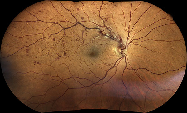 retinografía